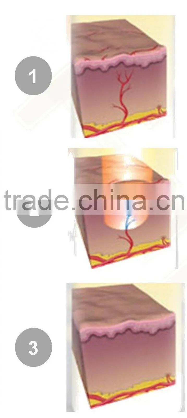 portable vascular vein removal medical beauty machine with CE certification