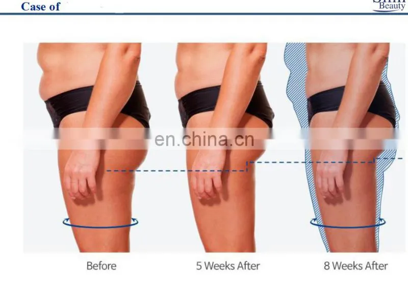 4 in 1 body sculpting machine of muscle building machine for fat removal