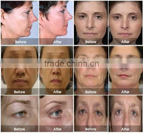 LM-S809B Factory price face lift hifu wrinkle removal, skin rejuvenation hifu face lifting machine