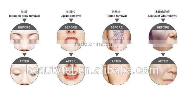 Beauty product Q switch nd yag laser working machine