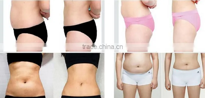 new !! best Focused ultrasound anti cellulite HIFU fat reducing machine / Bipolar RF head for face lifting