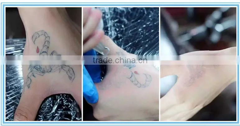 cheap q switch nd yag tattoo removal laser machine with top quality and medical ce approval