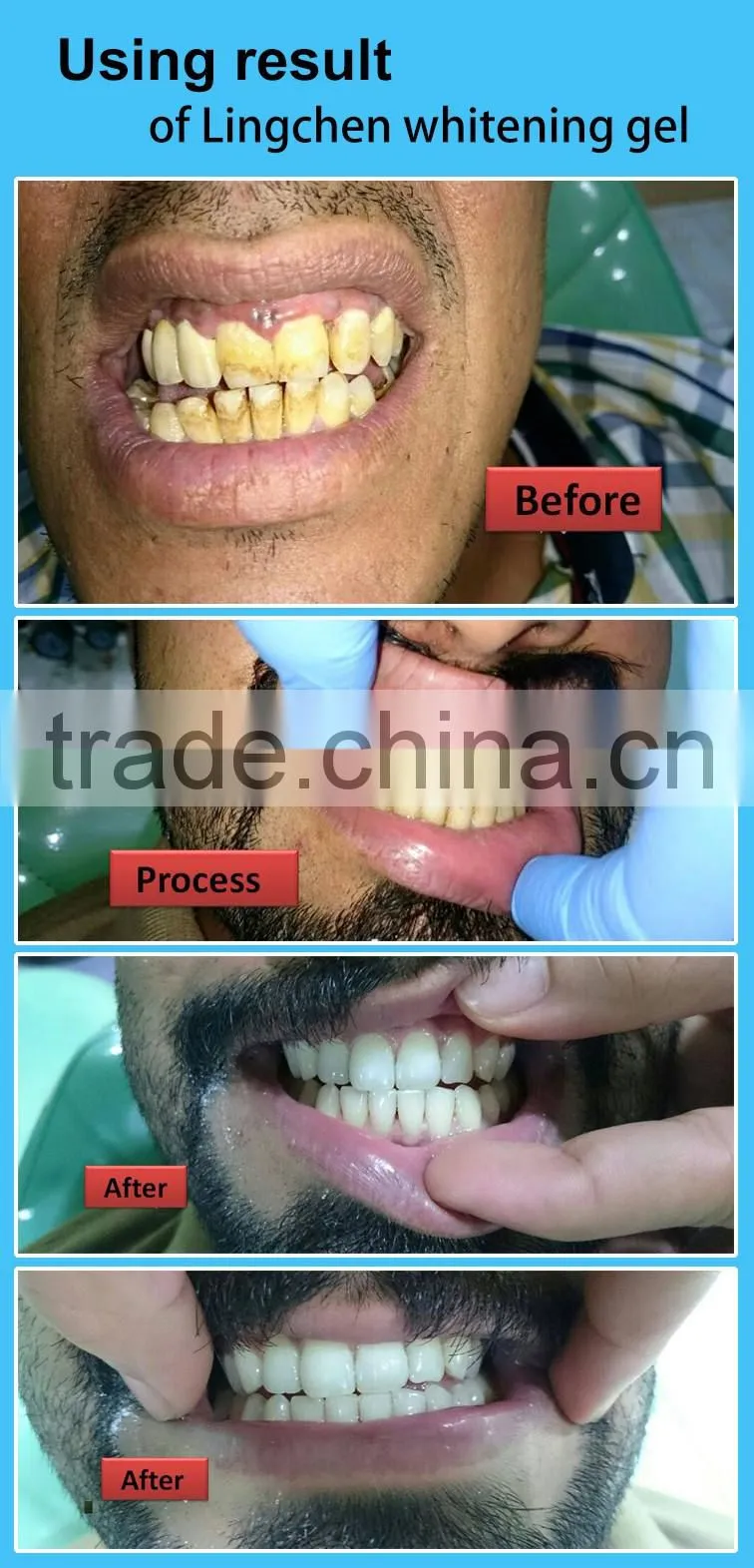 Best Dental Teeth Whitening Product Teeth Whitening Gel Made In USA, teeth cleaning kit