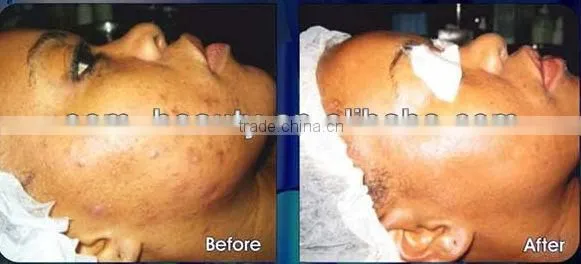 hot selling ipl age spots pigmentation hair removal machine ipl flash lamp rf nd yag laser machine for hair removal
