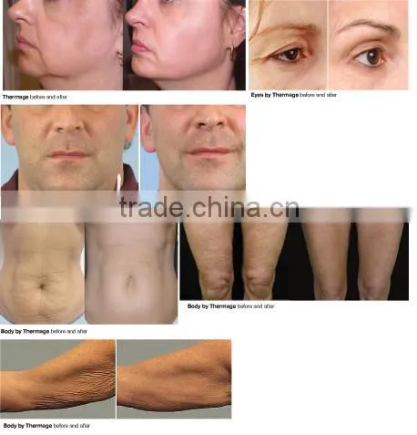 Hot selling !!! scarlet microneedle rf