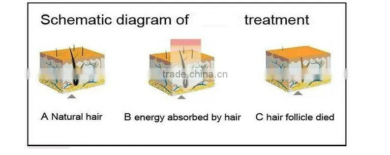Newest Design e-light Hair Removal Beauty Equipment/e-light Ipl+Rf Machine