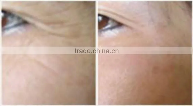 Auto Derma roller for wrinkle removal
