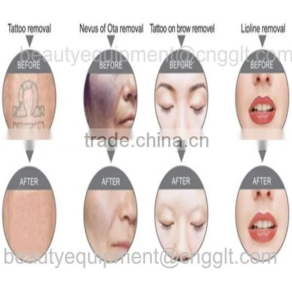 Factory price tattoo removal costs for black , red, brown,colorful tattoo