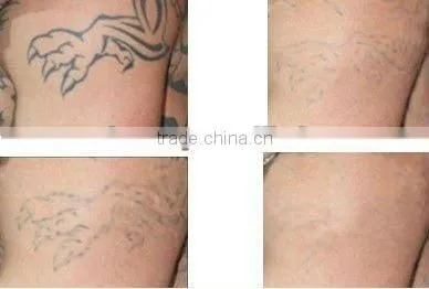 2012 Cheap portable laser machine for pigment blackhead removal