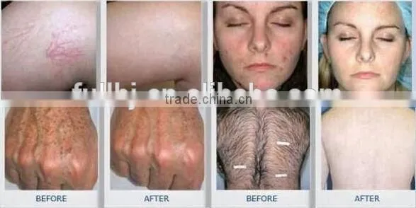 Multifunctional IPL Laser freckle removal machine