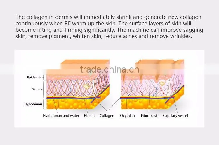 Professional RF skin neck wrinkle removal beauty machine