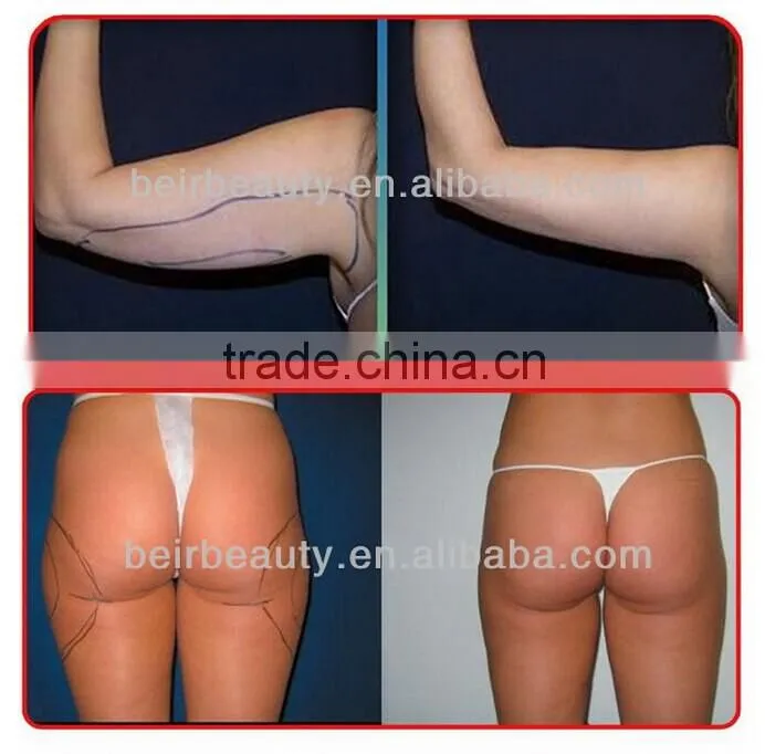 High Quality i diodes lipo laser /lipo machines for sale / Japan Mitsubishi Diode lipo laser