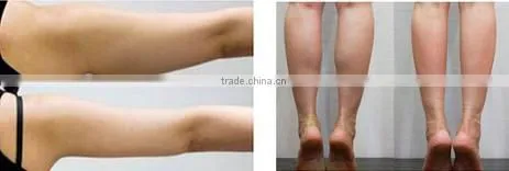 High Frequency Focused Ultrasound HIFU Slimming Machine