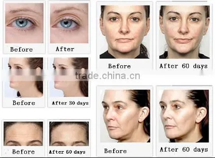 newest portable mini fractional rf dot matrix machine wrinkle remove facial lifting T29B