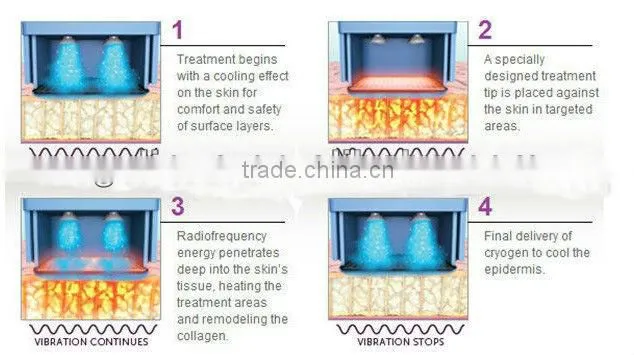 2013 lattest monpolar rf aesthetics equipment, Rhermage (Perfect skin rejuvenation result after just 1 time treatment!!!!)