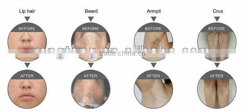 hot sale professional laser diode hair removal machine ipl shr machine
