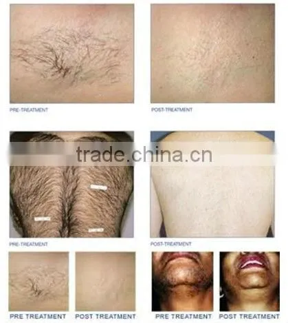 Immediately Result with Factory Promotion Price diode laser 808nm Hair Removal Machine
