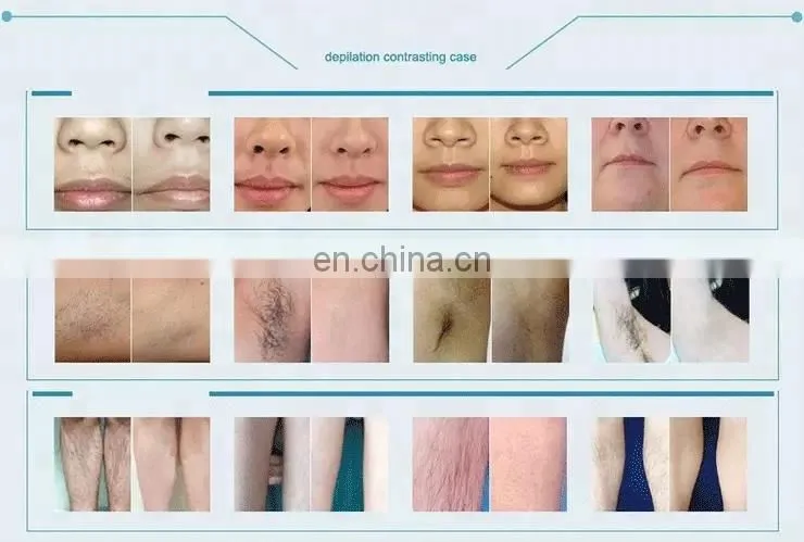 Mini Hair Removal Device IPL Photorejuvenation Depilatory Laser Beauty Instrument