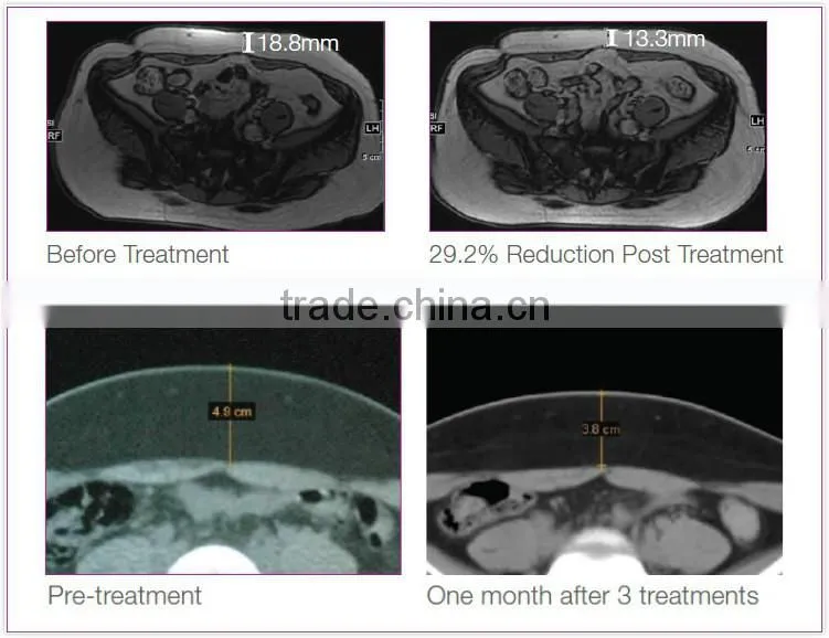 Ultrasound HIFU Liposonix Body Contouring Shaping With Fast Effect