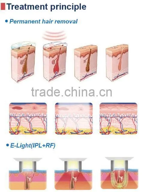 2015 multifunctional hair removal machine shr elight ipl light hair remove