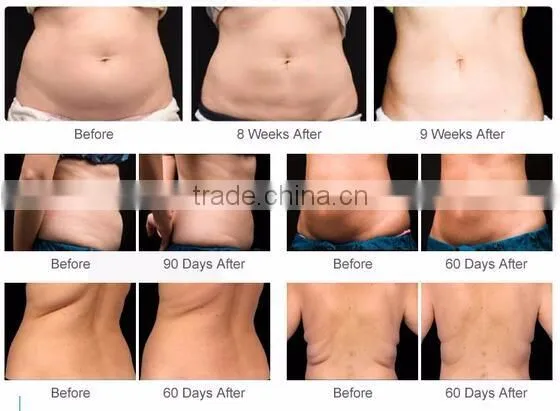 Newest products macchinario fat freezing lipolysis / criolipolisis machine