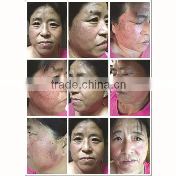 GGLT multifunctional beauty health hair removal for body and face
