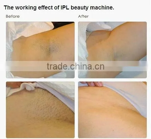 IPL RF Laser beauty equipment