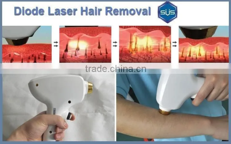 2016 Hot Selling Products permanent depilation diode laser