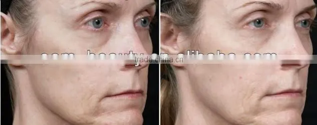 factory low price anti-aging acne removal rf beauty machine with CE certificate F-JT01