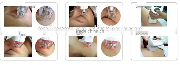 RF vacuum roller sliming machine ,face vacuum suction machine