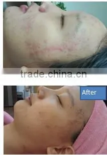 Water oxygen jet peel skin oxigenoterapia hydro dermabrasion water oxygen jet peel machine