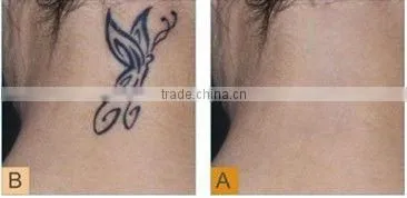 2013 best nd yag laser tattoo removal machine beauty salon equpment