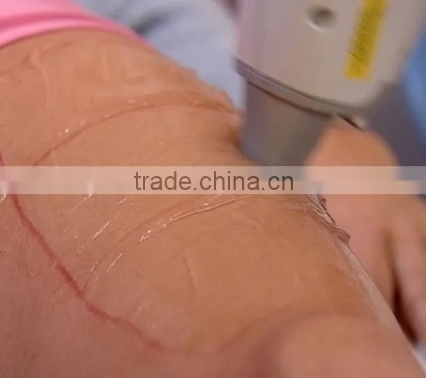 2015 Super cooling diode laser hair removal 808nm diode laser machine