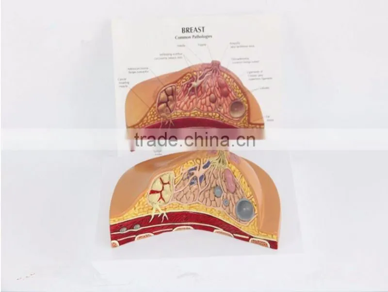 Medical breast disease model breast anatomical model medical training model breast feeding model