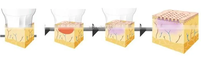 AYJ-T29(CE) fractional rf microneedle machine for home use/rf lifting machine/rf face lifting machine