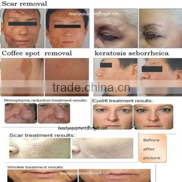 Portable CO2 Fractional Laser nd yag long pulse