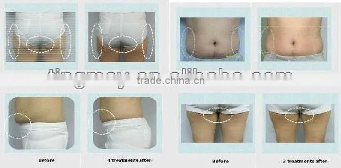 hot sale 40Khz (cavitation)ultrasound fat burning machine