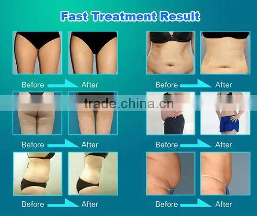 201 Big sale!! Powerful 7s cavitation cellulite reduction with vacuum rf (CE,ISO)