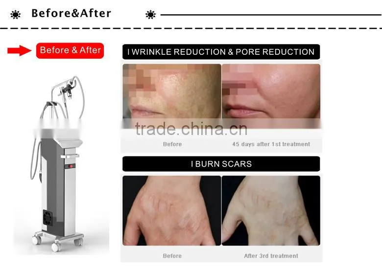 Micro needling Fractional RF skin care machine --MNF100