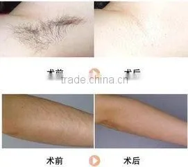 755nm Alexandrite laser machine with optimal & supper handle to remove hair painless