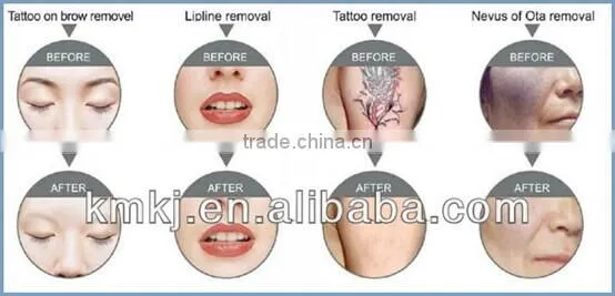 80% salon use 3 in 1 Multifunciotn SHR ND yag laser RF for hair ,wrinkle tattoo removal