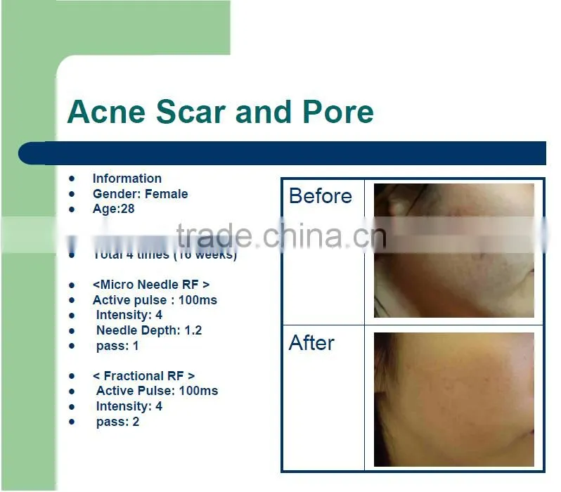 2016 best Micro Needle RF and Fractional RF system/ at home skin tightening machine