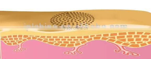 Super diode laser pixel radio frequency rf esthetic facial equipment - CE