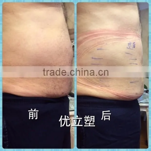 ultrashape body shaping slimming beauty aesthetic equipment