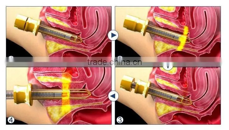 2016 Good effect 25mm focal length hifu vaginal tightening machine with CE certificate