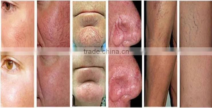 Best selling products 980nm diode laser spider veins removal machine/ high Frequency Spider Vein Removal Machine