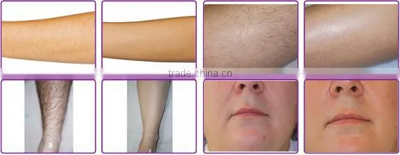 808 Hair Removal Machine wants distrobutor/ Laser hair remove for sale