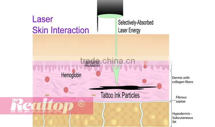 We looking for distributor q-switched nd:yag skin whitening & remove permanent tattoo machine / laser tatto removal machine
