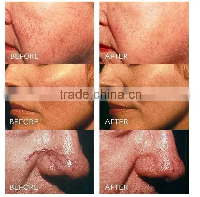 Portable 980nm Medical Diode Laser Spider Vein Removal Machine/980nm Laser Vascular Vein Removal Machine
