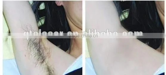 Hottest alex laser 755 alex alexandrite hair removal machine